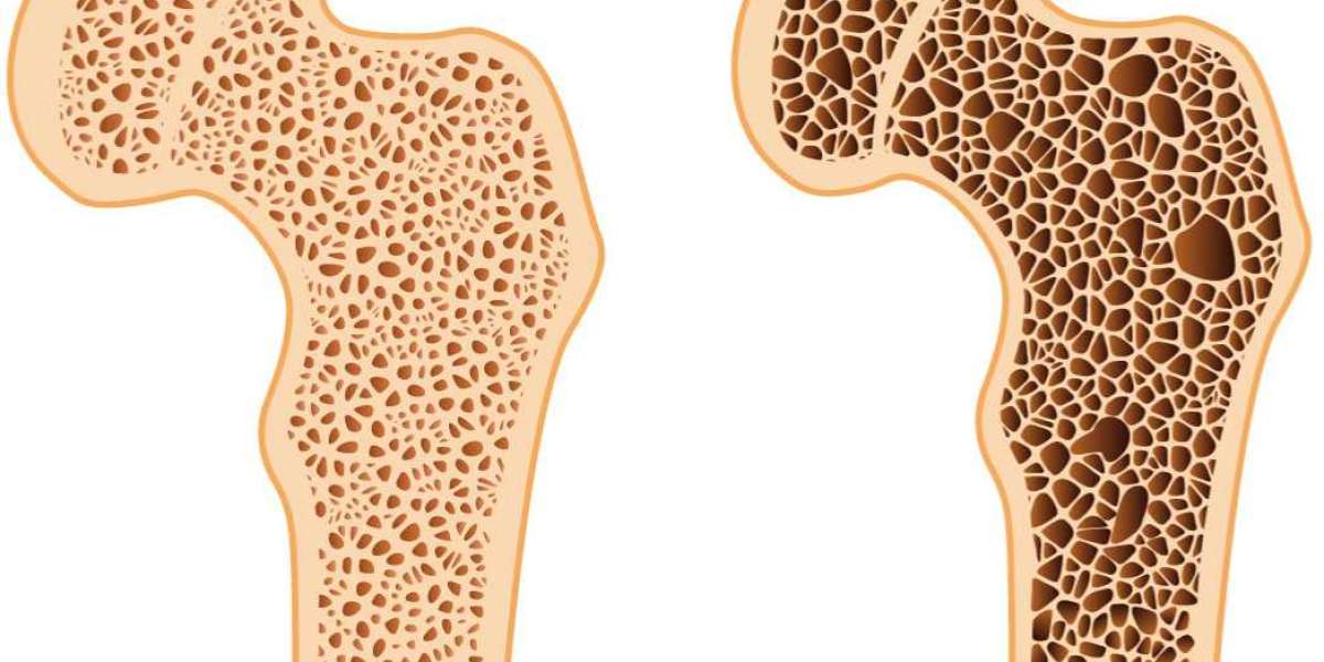 What You Should Know About the Development of Osteoporosis from Osteopenia?