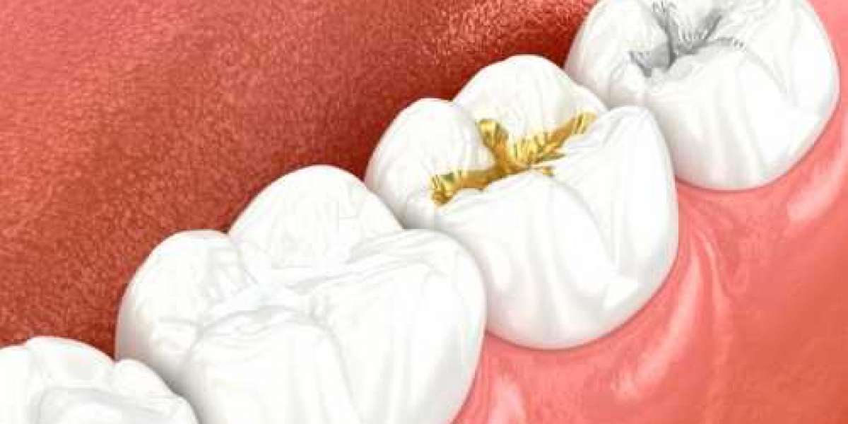 Dental Fillings Explained: Types, Benefits, and What to Expect