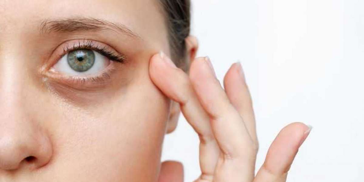 From Puffiness to Perfection: A Guide to Eye Bag Treatments